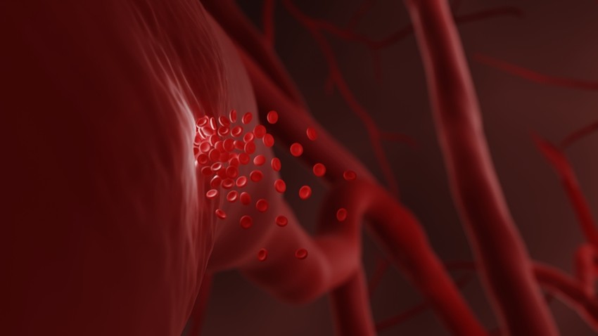 Az agyvérzés a világ egyik legrettegettebb megbetegedése, amely sokszor hirtelen, előzmények nélkül csap le. Mit él át az, akit épp agyvérzés ér?