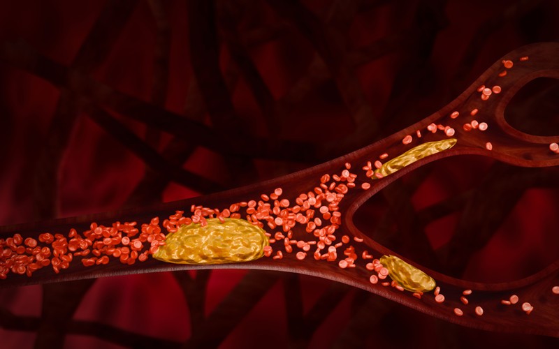 Plakkok az artériákban - ezek vezethetnek az erek elzáródásához