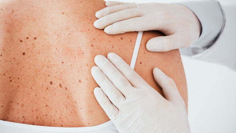 rákkutatás, melanoma, bőrrák, uv sugárzás