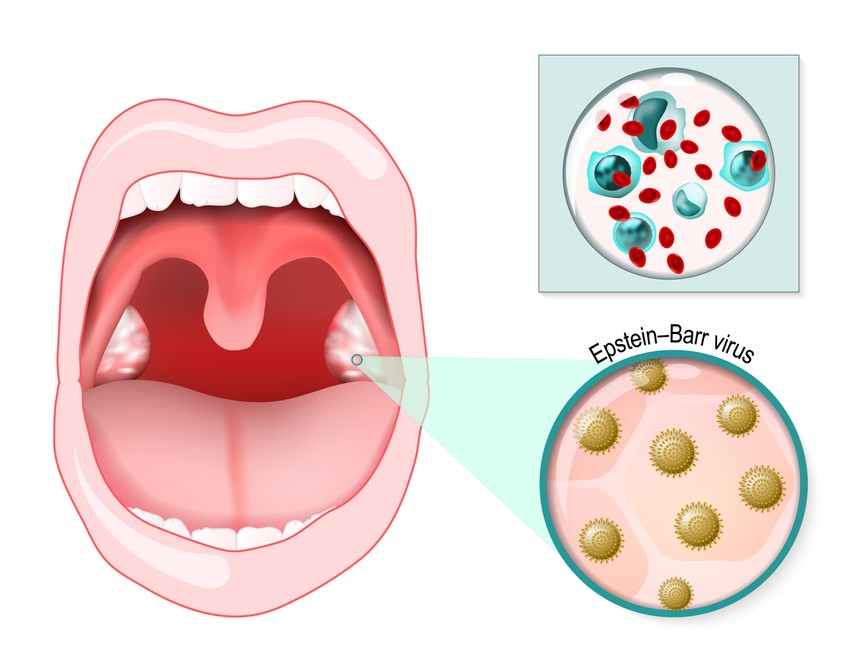 A torokfájás az első hét végén a legerősebb, a láz akár 2-3 hétig is folyamatosan fennmaradhat.