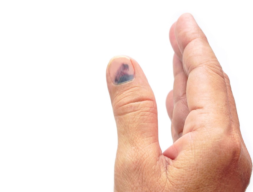 körömgombásodás köröm sárga vonalak fehér csík oka