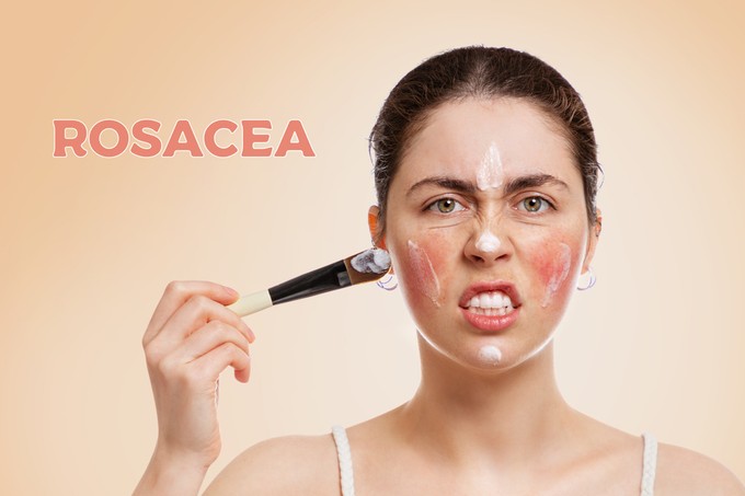 Rosacea: okai, tünetei és kezelése című cikk nyitóképe