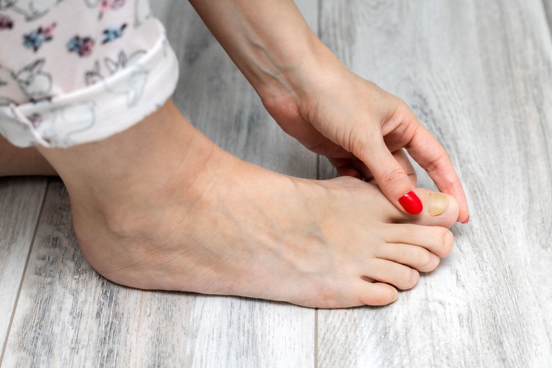 Így állíthatja meg a körömgomba terjedését, mielőtt nagyobb baj lenne