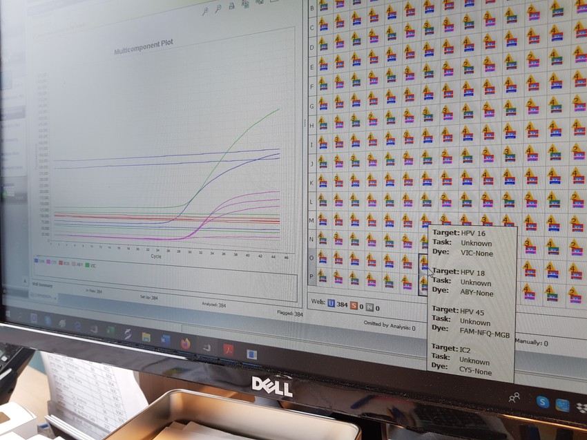 HPV-teszt eredménye: magas kockázatú HPV 16, 18 és 45 vírustörzsek a mintában