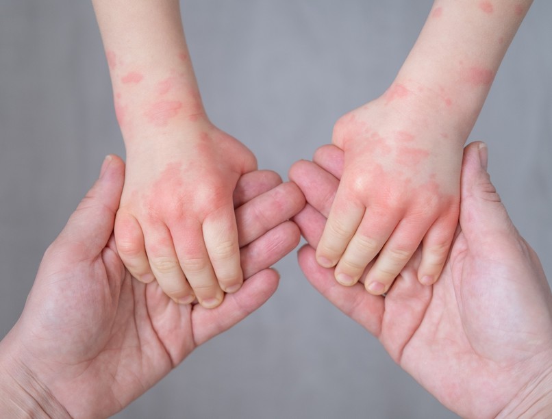 hidegtől új ételektől rosszabbodik ekcéma