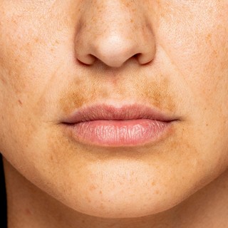 Mire utal a fokozott pigmentáció? című cikk nyitóképe