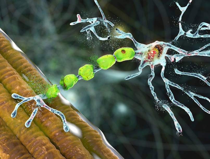 ALS amiotrófiás laterálszklerózis mozgató idegsejt betegség tünete kezelése