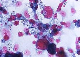 Egy kis riogatás: agyevő amőbák?