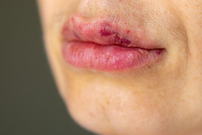 Felduzzadt a szája az ajakfeltöltés után, kiderült, hogy leukémiája van