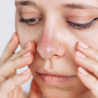 Vörös, sebes, duzzadt - ezeket árulhatja el az orra az egészségéről című cikk nyitóképe