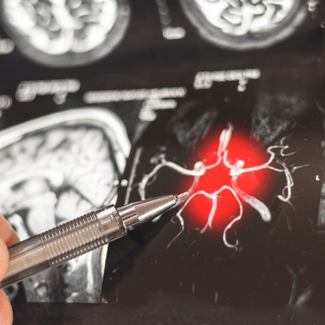 Forradalmi fordulat az Alzheimer-kutatásban: a K-vitamin új változata képes újjáépíteni az agysejteket című cikk nyitóképe
