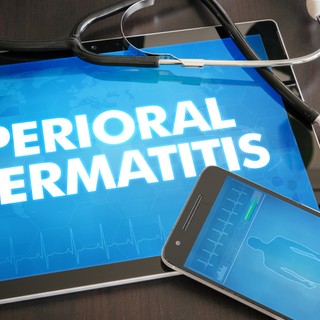 Periorális dermatitisz oka, tünetei és kezelése című cikk nyitóképe