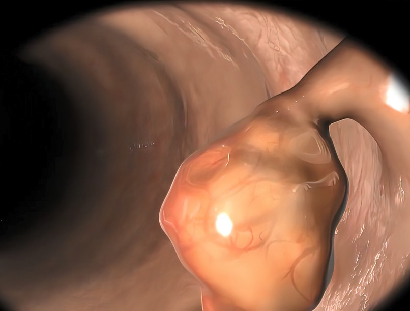 rossz szokás vastagbélrák vastagbél daganat tumor kockázat