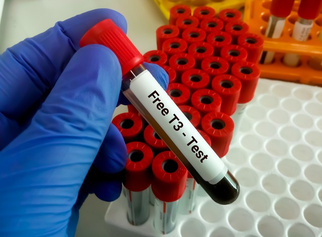 Mit jelent a FT3 (szabad T3) érték a laborleleten?