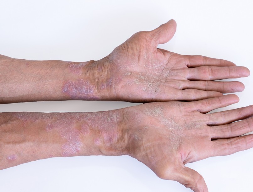 pikkelysömör pszoriázis kezelés terápia magyarország