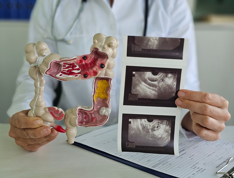 bélrendszer vizsgálat béltükrözés kolonoszkópia