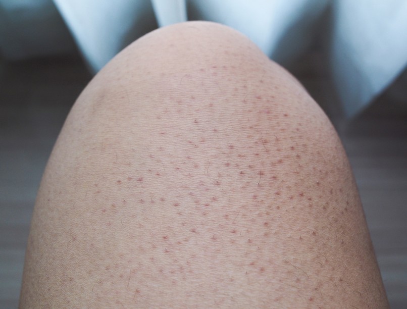grízes bőr, keratosis, pilaris, libabő, csirkebőr, göbök, kiütés, száraz bőr, keratin