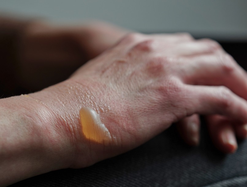 Mi a Vízhólyag vesiculae cutis