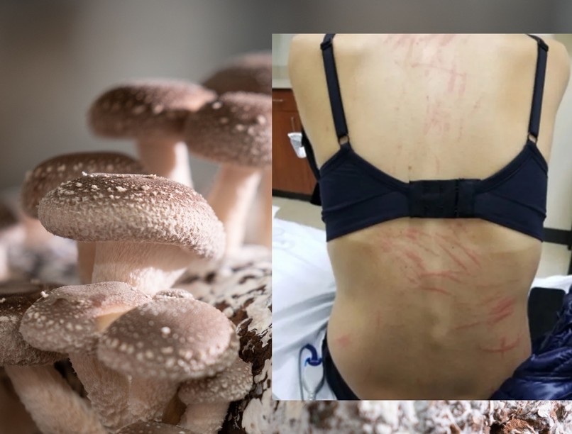 kiütések shiitake gomba evés után