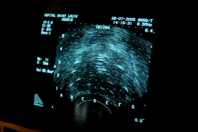 Mi a brachyterápia? című cikk nyitóképe