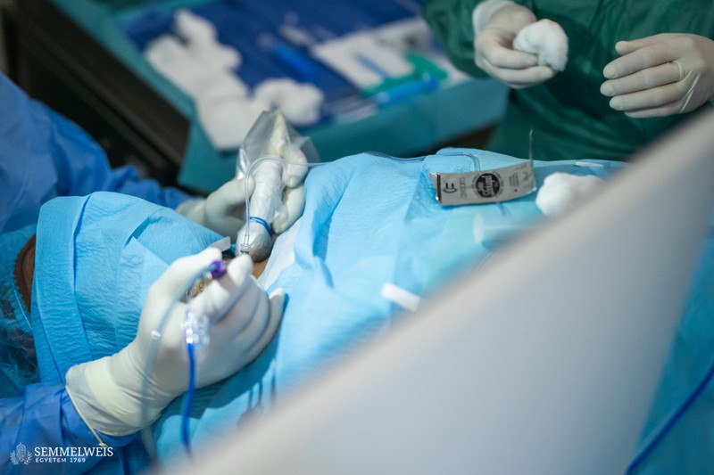 Mellékpajzsmirigy megnagyobbodást kezeltek termoablációval a Semmelweisen