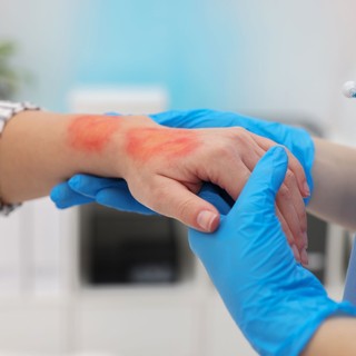 Égés, forrázás tünetei, vizsgálata és kezelése című cikk nyitóképe