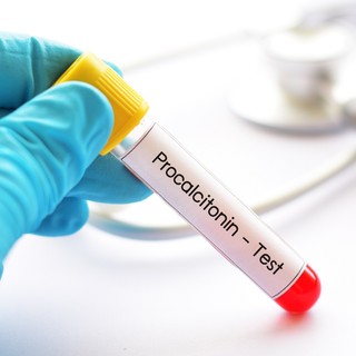 Mit jelent a prokalcitonin (PCT) érték a laborleleten? című cikk nyitóképe