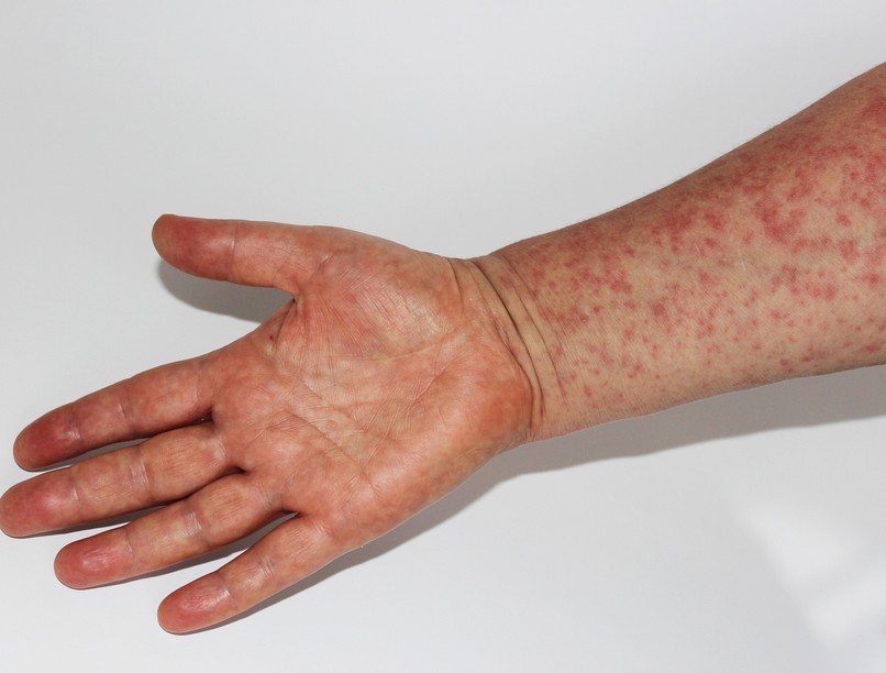 hirek Marokkói kanyaróvírus Brüsszel