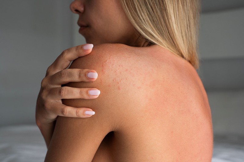 Ez a kellemetlen allergia az egész nyaralást tönkreteheti – amint jelentkezik árnyékba kell húzódni!