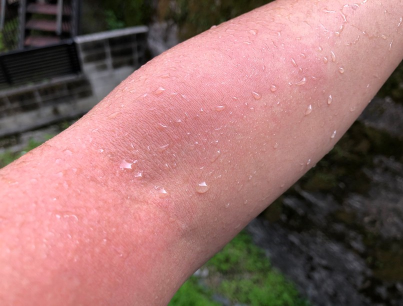 allergia vízallergia csalánkiütés víztől