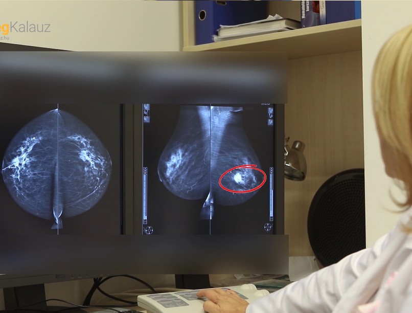 emlőrák, mammográfia, mellrág, daganatos betegségek, szűrővizsgálat