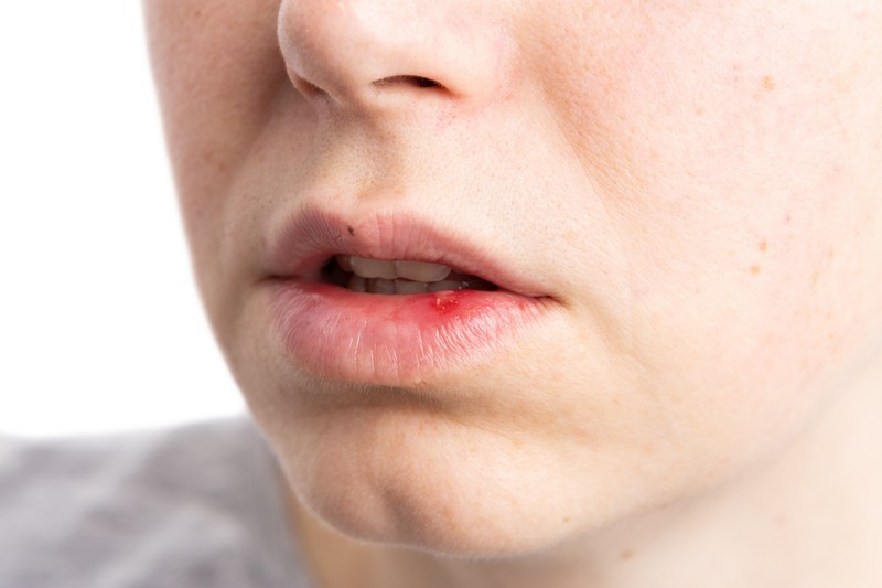 Apró kiütések, hólyagok, dudorok a szájon: ezek a betegségek okozhatják