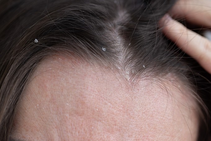 Mi a különbség a zsíros és a száraz korpa között, és mit lehet tenni ellenük? című cikk nyitóképe