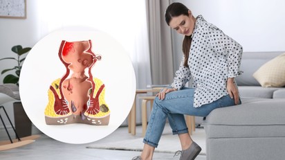 Lüktető fájdalom és makacs váladékozás a végbélből: felejtse el a házi kenegetést! Ez az egyetlen valódi megoldás a sipoly ellen című cikk nyitóképe