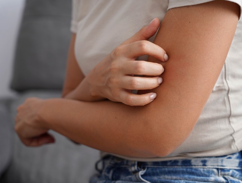 apró, viszkető kiütés, melegkiütés