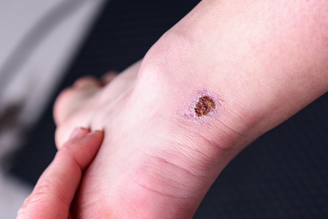 Mit jelent a sebgyógyulási zavar?