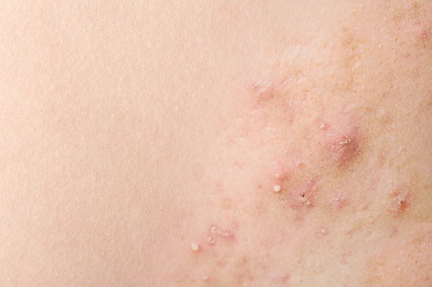 Az acne kezelésénél a kiváltó ok(ok)at kezeljük. Csökkentjük a faggyú termelését, fokozzuk az elhalt hámsejtek leválását, csökkentjük a baktériumok számát, csillapítjuk a gyulladást, vagy mind a négyet egyszerre kezeljük.