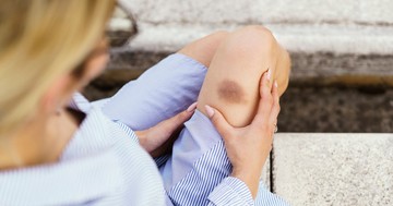 Tele van véraláfutással a bőre? Ezek a betegségek okozhatják