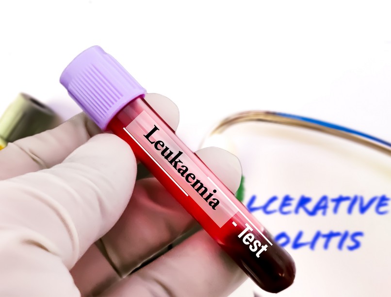 Mi a különbség az akut és a krónikus limfocitás leukémia között