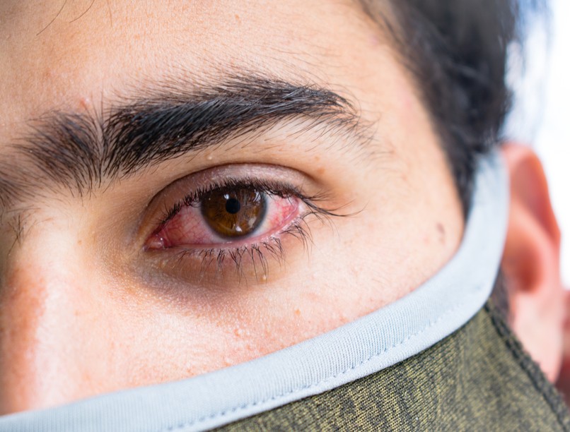 feketegomba-fertőzés, delta variáns, indiai variáns, koronavírus, tünetei