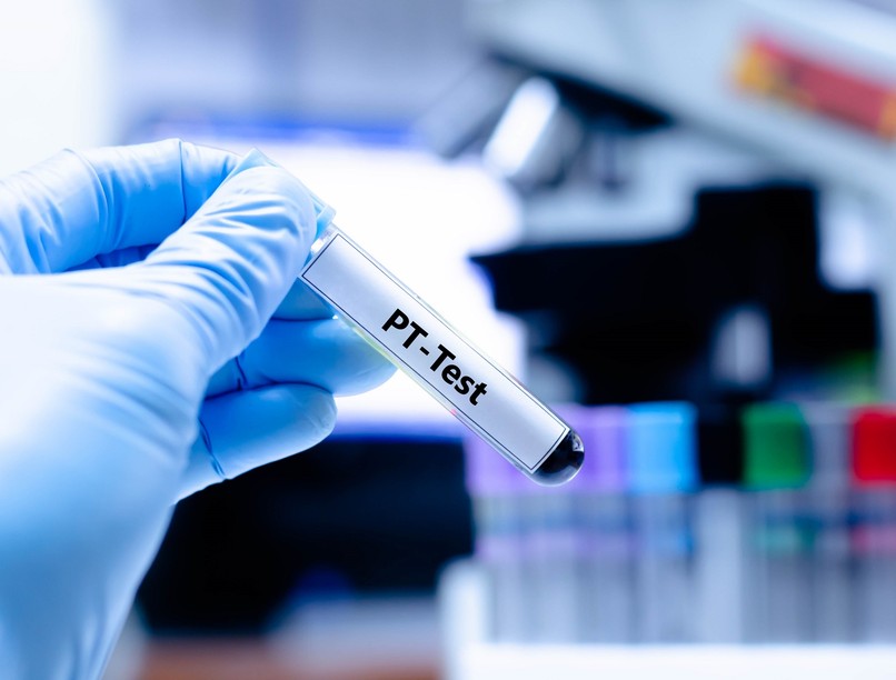 Mit jelent protombin idő PT érték laborlelet