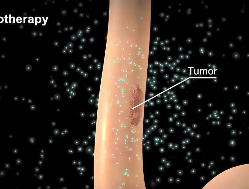 Mit jelent a megelőző kemoterápia adjuváns kezelés