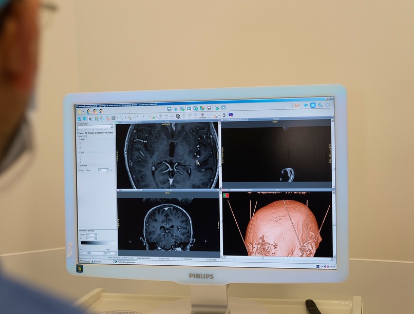 mély agyi stimuláció deep brain stimulation dbs kezelés leírás