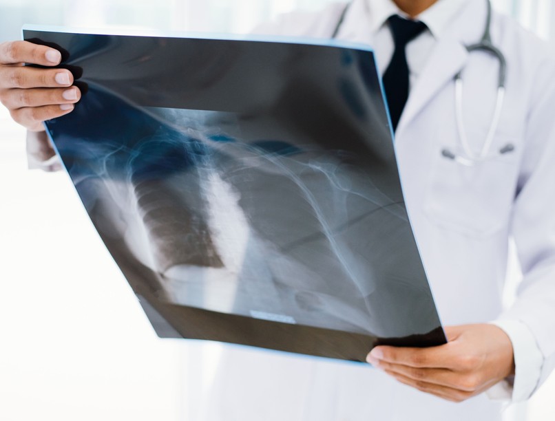 tüdőrák tünet korai késői stádium