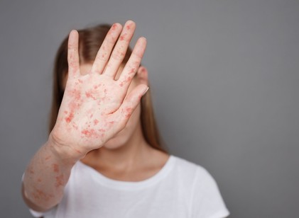 Hiába a vakcina, mégis terjed: miért nem tűnik el a kanyaró Európából? című cikk nyitóképe