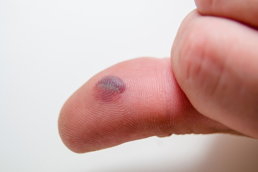 A vérhólyag egy vörös, folyadékkal teli hólyag, amely érintésre nagyon fájdalmas lehet.