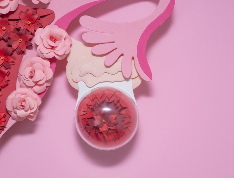 Petefészekciszta, petefészek, tüszőciszta, sárgatestciszta, endometrioma, ciszta megrepedése