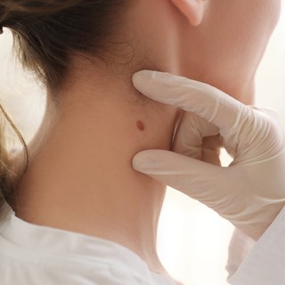 Anyajegy eltávolítás nyár előtt - miért érdemes időben lépni? című cikk nyitóképe