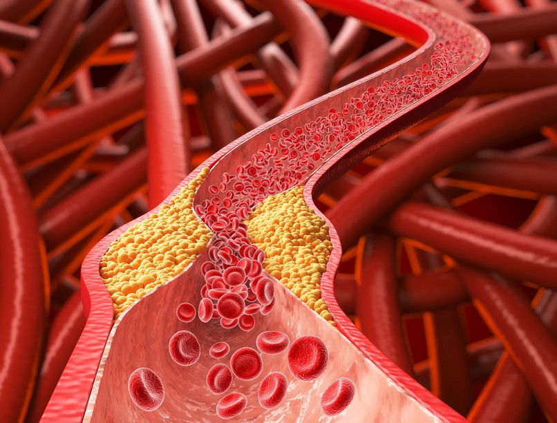 magas koleszterinszint ellen mit együnk