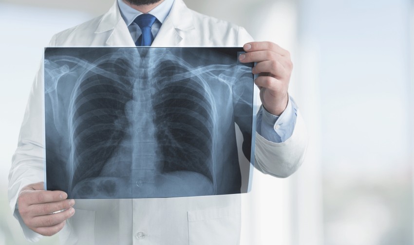 A bronchitis tulajdonképpen azoknak a hörgőknek a gyulladása, amelyek a belélegzett levegőt a tüdő hólyagocskáihoz szállítja.